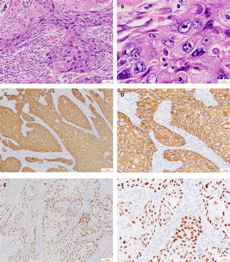 Hande Staining And Immunohistochemical Staining Hande Stain Was Shown As Download Scientific