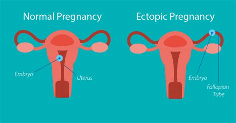 Ectopic Pregnancy Causes Sypmtoms Diagnosis Treatment How To Relief