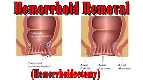 Hemorrhoid Removal Hemorrhoidectomy Natural Health Cures Youtube