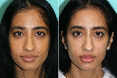 Cheeks Midface Injections Photos Chevy Chase Md Patient 21311