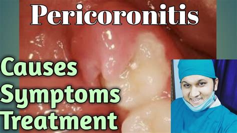 Pericoronitis Types Causes Signs Symptoms Treatments Youtube