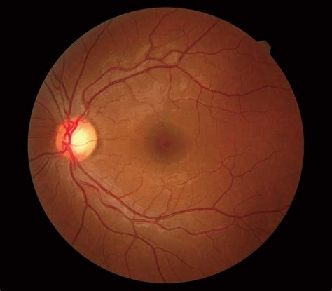 Dilated Fundus Evaluation In Pickering On Seaton Vision Care