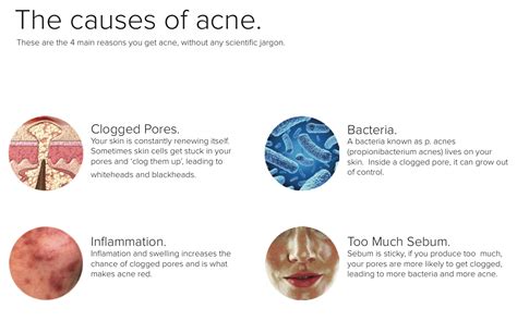 The Causes Of Acne There Are 4 Main Causes