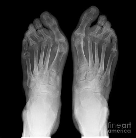 Arthritic Feet X Ray Photograph By Science Photo Library