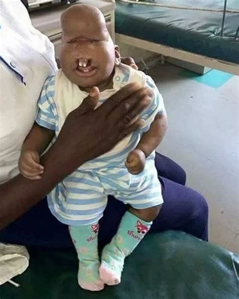 Parents Reject Newborn With Facial Deformities Call Her An Alien