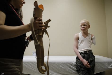 Albino Children In Tanzania Who Lost Limbs Get Prostheses Daily Mail