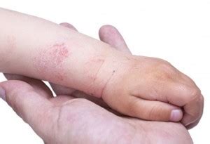 Dermatite Atopica Nei Bambini Sintomi E Cure Punto E Virgola Mamma