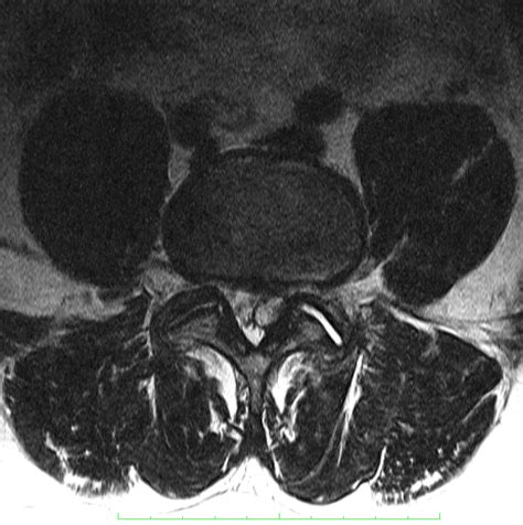 Intraspinal Synovial Cyst Image
