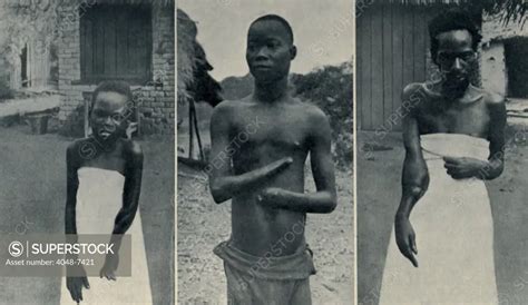 Atrocities Of The Rubber Slavery In The Belgian Congo Mongala Left And Biasia Right Arms