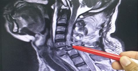 Cervical Spine Injury Image Mri Scan Picture Id