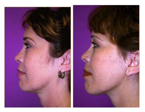 Face Lift Picture Gallery Christopher T Johnson Dmd Facs