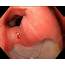 Duodenal Ulcer Endoscope View  Stock Image C033/9758 Science