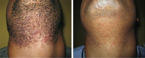 Never Suffer From Ingrown Hairs Again London Premier Laser And Skin Clinic