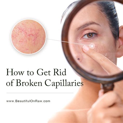 How To Get Rid Of Broken Capillaries Beautiful On Raw