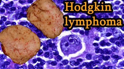 Hodgkin Lymphoma Simply Explained Symptoms Causes Prognosis Treatment Youtube