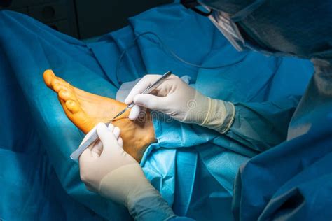 A Surgeon Makes An Incision On One Foot With A Scalpel Stock Image