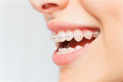 How To Brush Your Teeth With Braces A Simple Guide Yuba City
