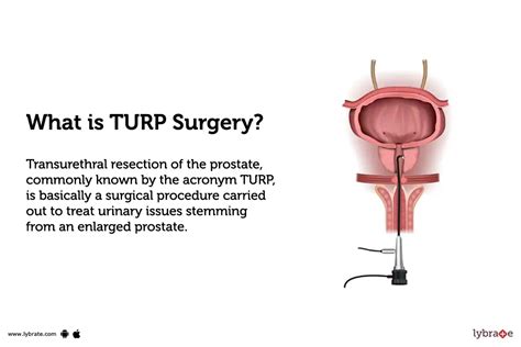 Transurethral Resection Of The Prostate Turp Purpose Procedure Benefits And Side Effects