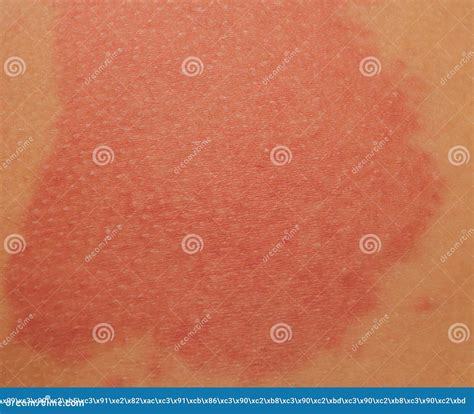 Urticaria Or Hives On The Back On The Shoulder Red Rashes Itchy Bumps Stock Image Image Of