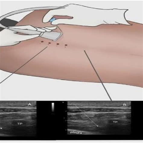 Ultrasound Guided Thoracic Paravertebral Block A Local Anaesthetic