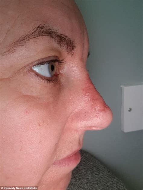 Woman Has A Scar On Her Nose After A Pore Turned Out To Be Cancer