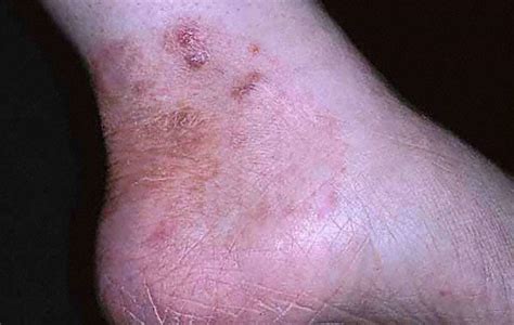 Fungal Rash On Foot