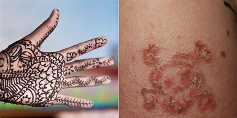 You've heard horror stories of peoples' ink getting infected and warping the it's actually a form of an allergic reaction. 10-Year-Old Boy Suffers Allergic Reaction to Black Henna Tattoo - Photos