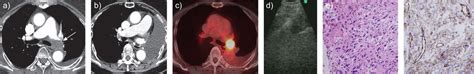 Ebus Tbna In The Differential Diagnosis Of Pulmonary Artery Sarcoma And