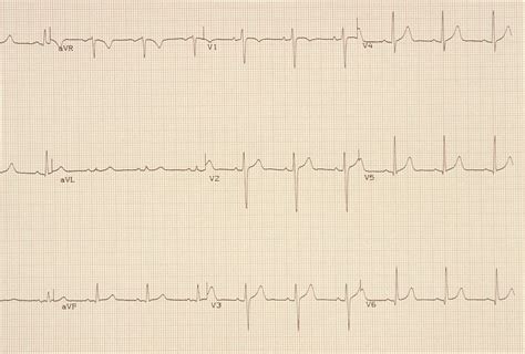 Electrocardiogram Ecg Or Ekg Procedure And Results