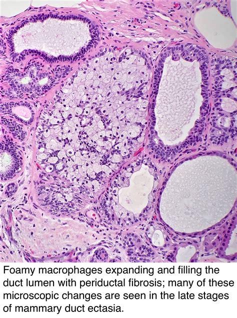 Pathology Outlines Duct Ectasia