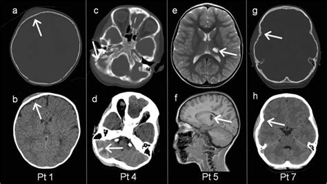 Abnormal Neuroimaging Findings At Re Presentation Ct Scan Images Of
