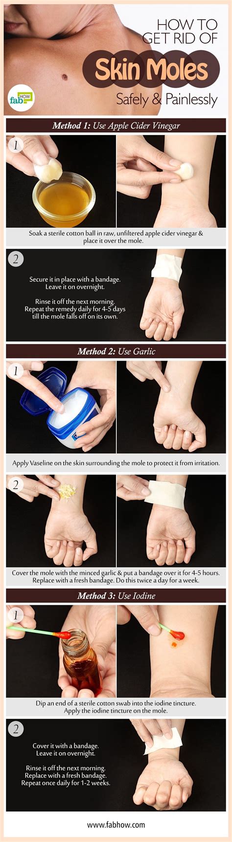 How To Get Rid Of Moles Infographic Embed Skin Remedies Get Rid Of