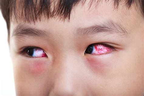 Pink Eye Conjunctivitis In Children 13 Symptoms And Treatment