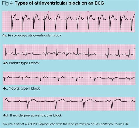 Electrocardiogram Cardiac Rhythm And Conduction Abnormalities Nursing Times