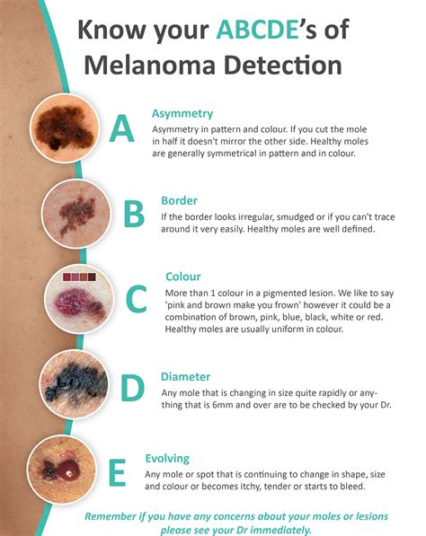 How To Check Your Moles And Freckles For Melanoma Work Health