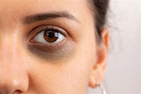 Black Eye Causes Treatment And Complications