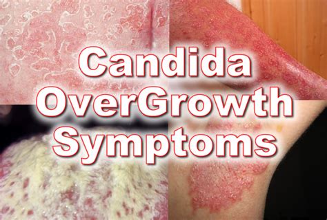 What Is Candida And Could You Have An Overgrowth In Your System