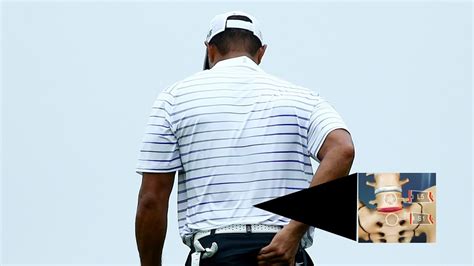 A Look At Tiger Woods L S Spinal Fusion Back Surgery Youtube