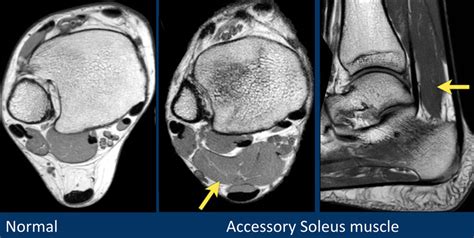 The Radiology Assistant : Ankle - MRI examination