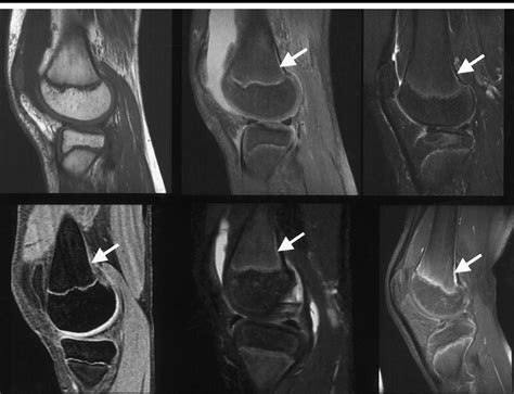 Sagittal Mr Images Of The Knee Obtained By Using Nonenhanced