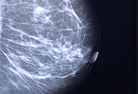 What is ductal carcinoma in situ? A Visual Guide to Breast Cancer