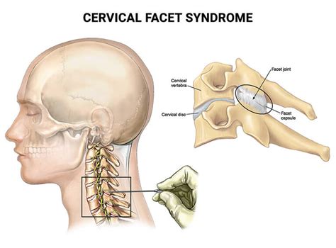 THE REAL PAIN IN THE NECK FACET SYNDROME SD Body Fix