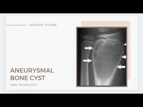 ANEURYSMAL BONE CYST YouTube