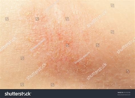 Macro Of Eczema On Little Girl Arm Skin Stock Photo 59193790 Shutterstock
