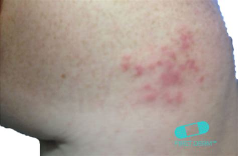 Rash Pinpoint Red Dots On Skin Wickedpoliz