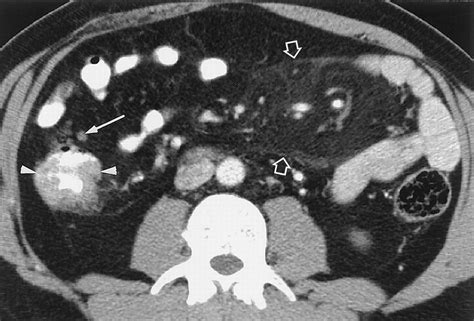 Disproportionate Fat Stranding A Helpful Ct Sign In Patients With