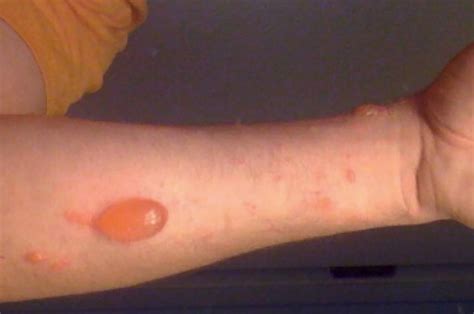 Poison Ivy Rash On Human Skin By Science Stock Photographyscience
