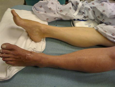 A Case Of A Painful Swollen Leg Annals Of Emergency Medicine