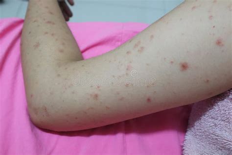 Close Up Of The Skin On The Arm Of Women With Skin Diseases Allergies