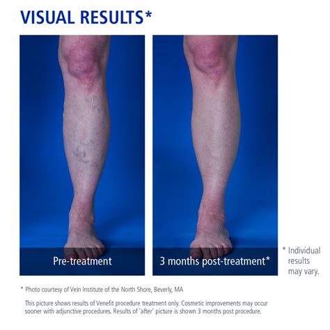 Varicose Vein Treatments Advanced Vein Center Of Medford